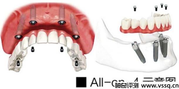 三种满口假牙的价格介绍