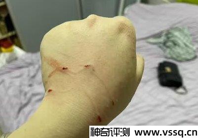 被猫咬千万不要打狂犬疫苗吗？是错的(价格60元一针打5次)