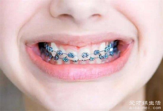 牙套的价格是多少？